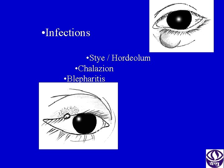  • Infections • Stye / Hordeolum • Chalazion • Blepharitis 