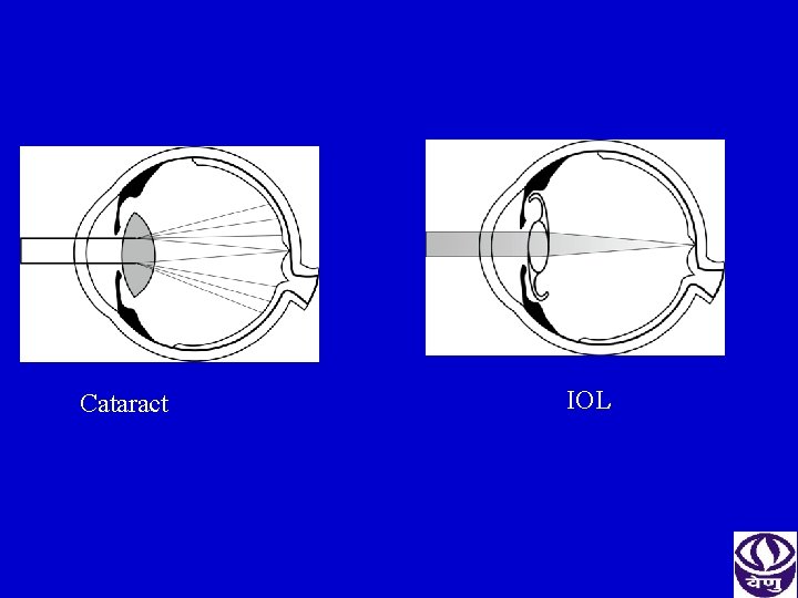 Cataract IOL 