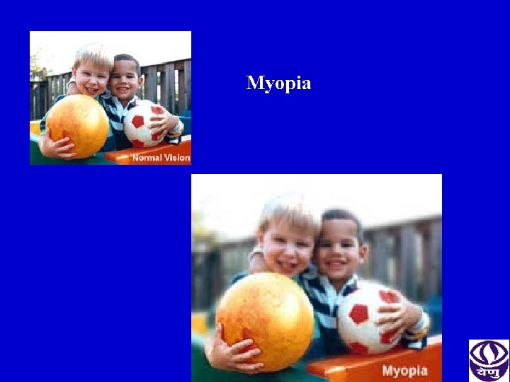 Myopia 