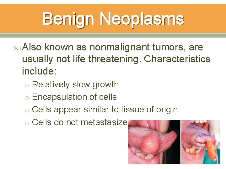 Benign Neoplasms Also known as nonmalignant tumors, are usually not life threatening. Characteristics include: