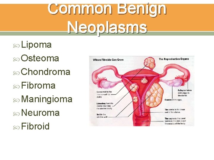 Common Benign Neoplasms Lipoma Osteoma Chondroma Fibroma Maningioma Neuroma Fibroid 