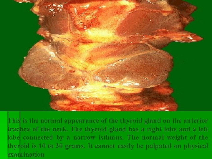 This is the normal appearance of the thyroid gland on the anterior trachea of This is the normal appearance of the thyroid gland on the anterior trachea of