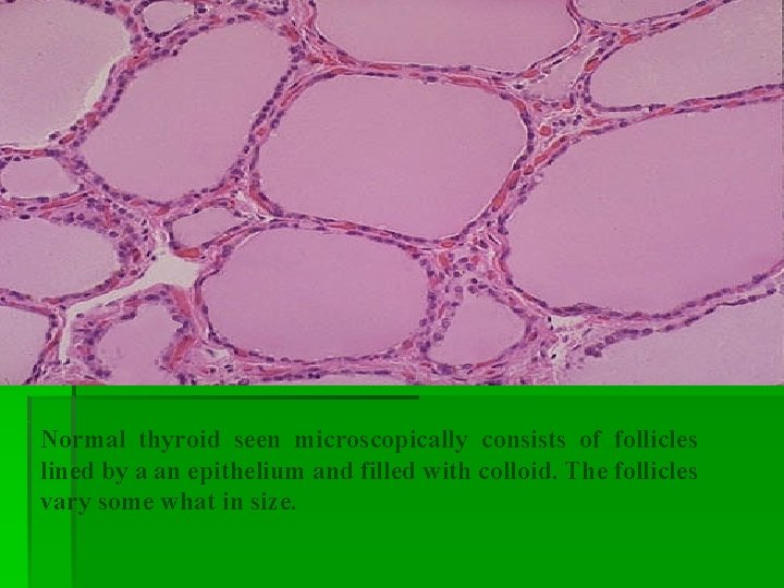 Normal thyroid seen microscopically consists of follicles lined by a an epithelium and filled Normal thyroid seen microscopically consists of follicles lined by a an epithelium and filled