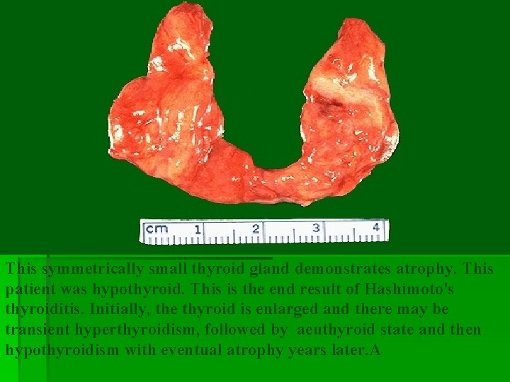 This symmetrically small thyroid gland demonstrates atrophy. This patient was hypothyroid. This is the This symmetrically small thyroid gland demonstrates atrophy. This patient was hypothyroid. This is the