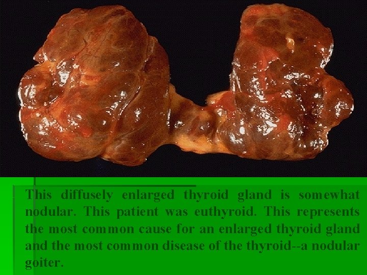This diffusely enlarged thyroid gland is somewhat nodular. This patient was euthyroid. This represents This diffusely enlarged thyroid gland is somewhat nodular. This patient was euthyroid. This represents