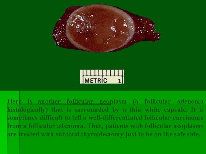 Here is another follicular neoplasm (a follicular adenoma histologically) that is surrounded by a Here is another follicular neoplasm (a follicular adenoma histologically) that is surrounded by a