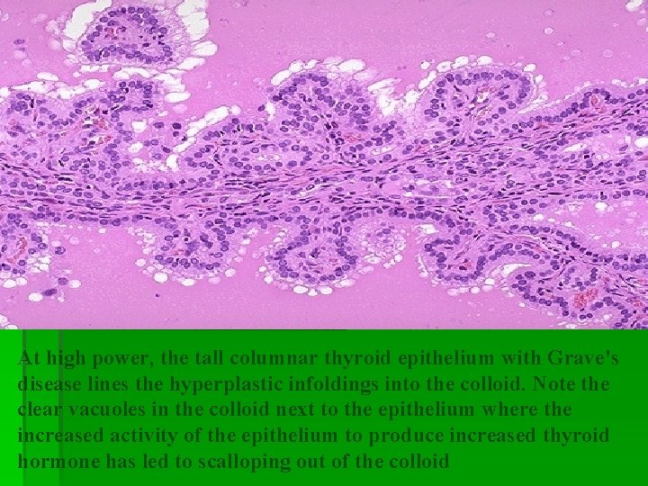 At high power, the tall columnar thyroid epithelium with Grave's disease lines the hyperplastic At high power, the tall columnar thyroid epithelium with Grave's disease lines the hyperplastic