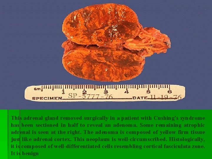 This adrenal gland removed surgically in a patient with Cushing's syndrome has been sectioned This adrenal gland removed surgically in a patient with Cushing's syndrome has been sectioned