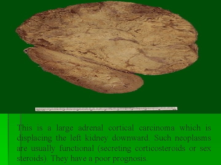 This is a large adrenal cortical carcinoma which is displacing the left kidney downward. This is a large adrenal cortical carcinoma which is displacing the left kidney downward.