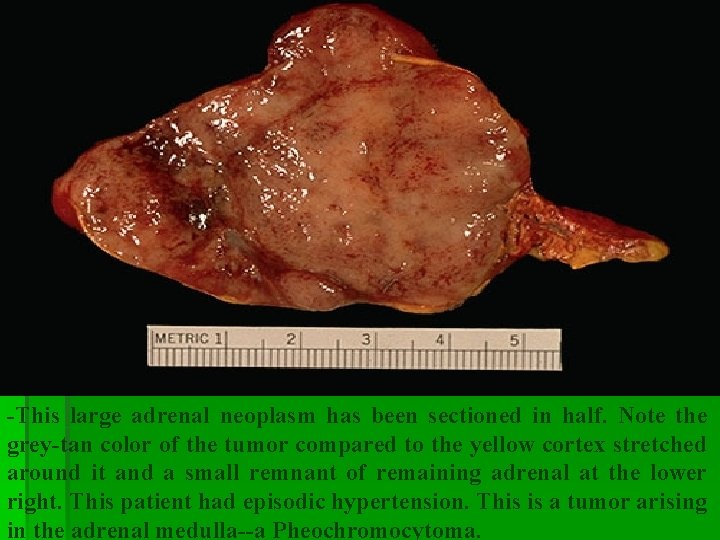 -This large adrenal neoplasm has been sectioned in half. Note the grey-tan color of -This large adrenal neoplasm has been sectioned in half. Note the grey-tan color of