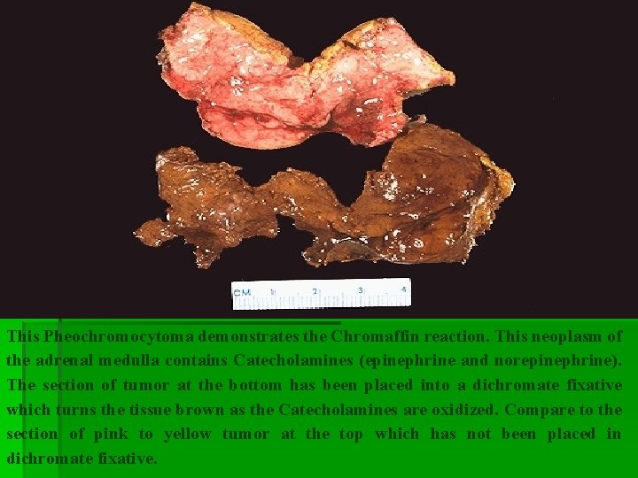 This Pheochromocytoma demonstrates the Chromaffin reaction. This neoplasm of the adrenal medulla contains Catecholamines This Pheochromocytoma demonstrates the Chromaffin reaction. This neoplasm of the adrenal medulla contains Catecholamines