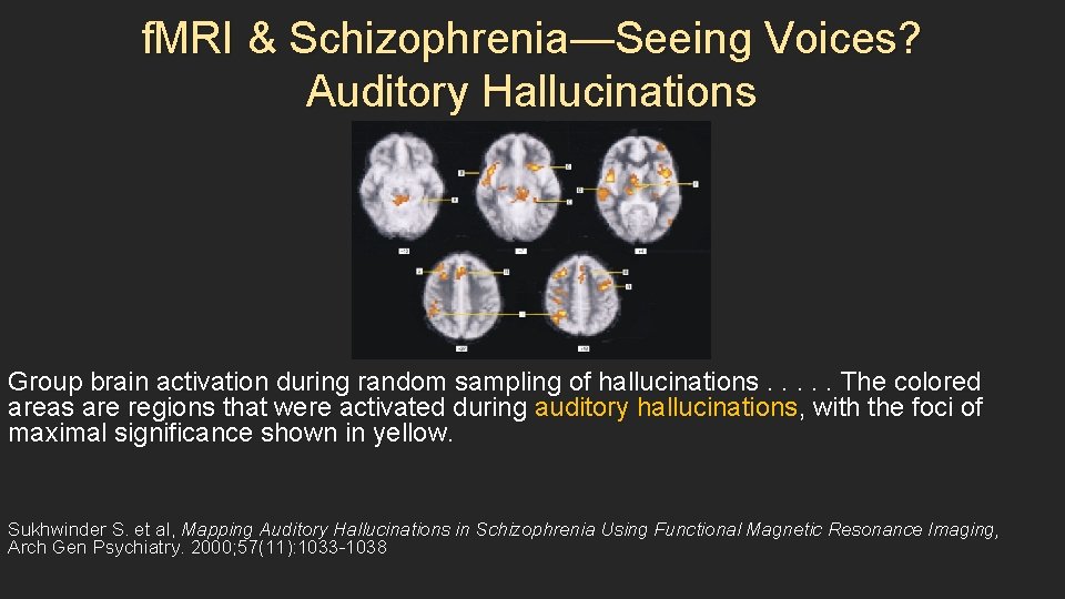 f. MRI & Schizophrenia—Seeing Voices? Auditory Hallucinations Group brain activation during random sampling of