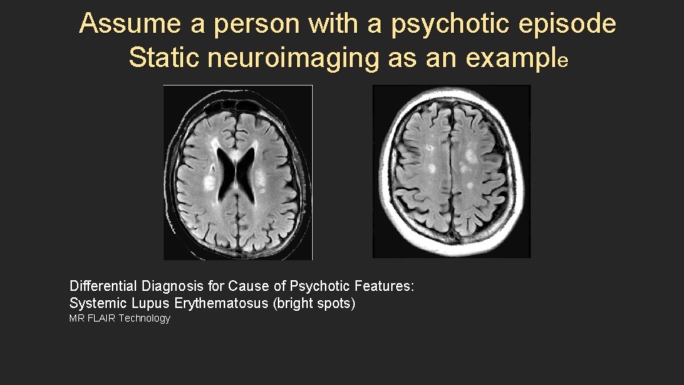 Assume a person with a psychotic episode Static neuroimaging as an example Differential Diagnosis