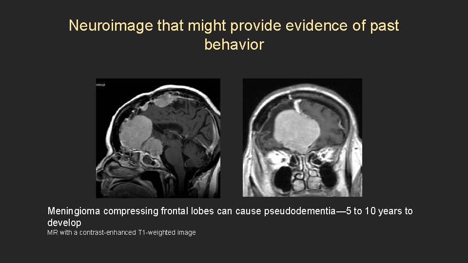 Neuroimage that might provide evidence of past behavior Meningioma compressing frontal lobes can cause