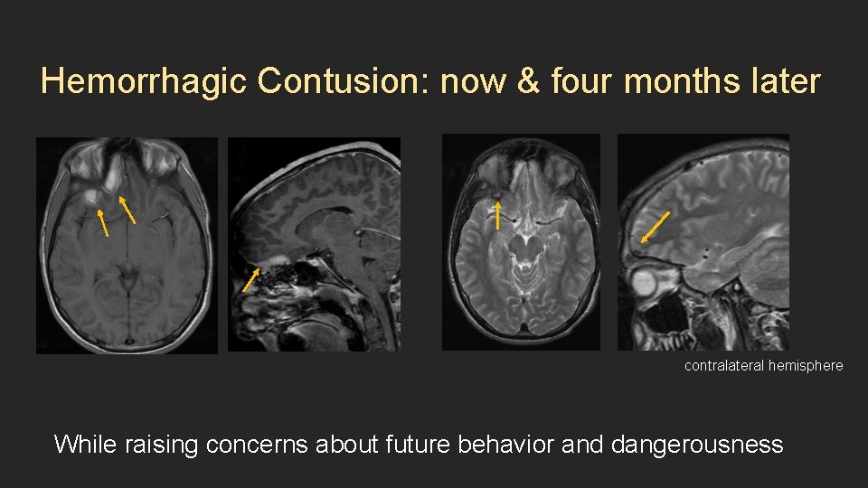 Hemorrhagic Contusion: now & four months later contralateral hemisphere While raising concerns about future