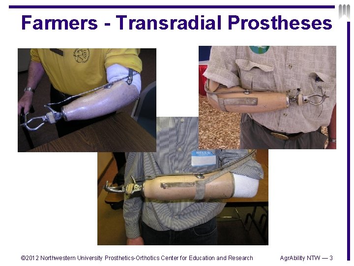 Farmers - Transradial Prostheses © 2012 Northwestern University Prosthetics-Orthotics Center for Education and Research