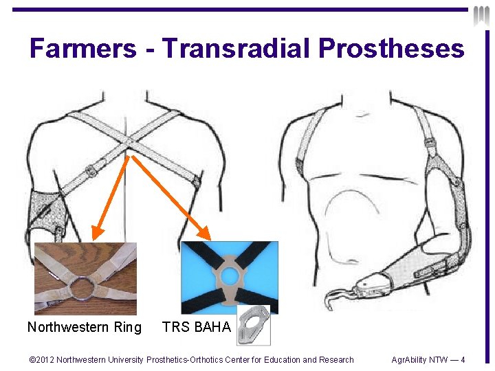 Farmers - Transradial Prostheses Northwestern Ring TRS BAHA © 2012 Northwestern University Prosthetics-Orthotics Center