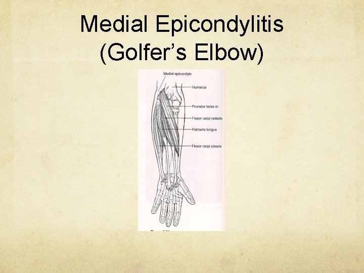Medial Epicondylitis (Golfer’s Elbow) 