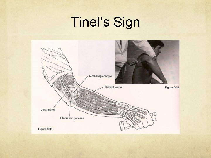 Tinel’s Sign 