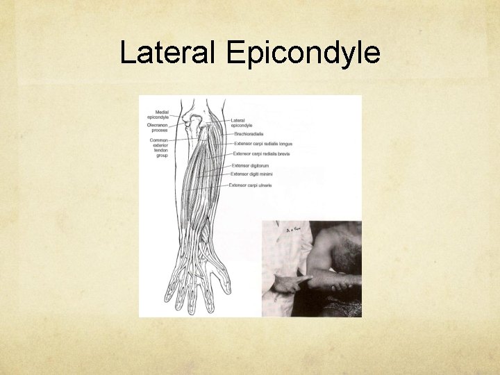 Lateral Epicondyle 