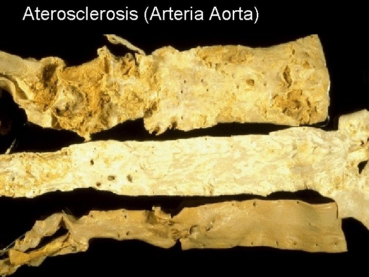 Aterosclerosis (Arteria Aorta) 