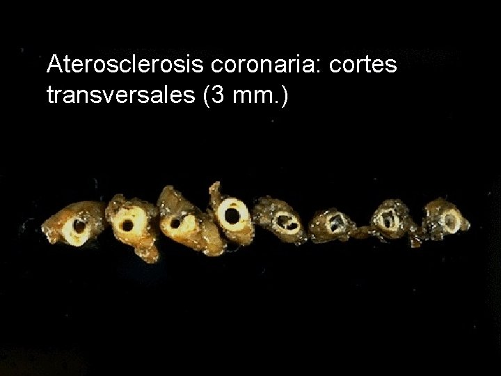Aterosclerosis coronaria: cortes transversales (3 mm. ) 