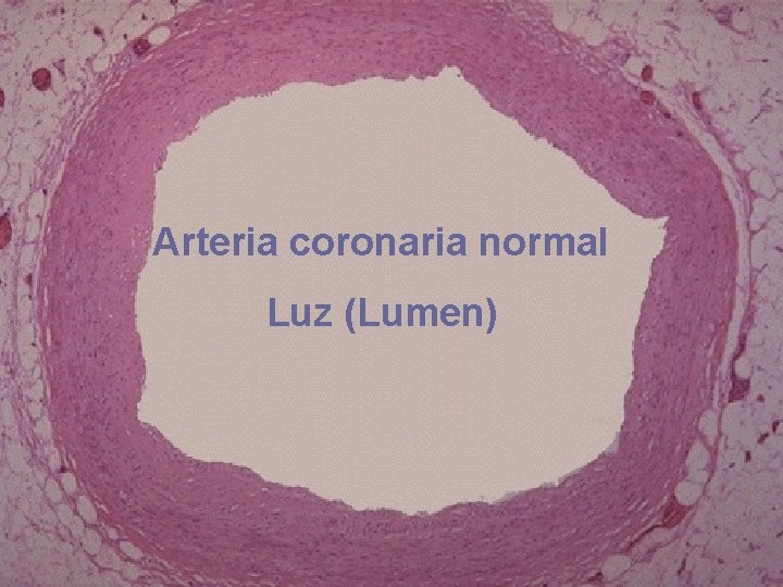 Arteria coronaria normal Luz (Lumen) 