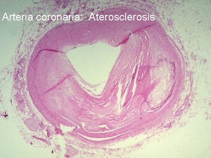 Arteria coronaria: Aterosclerosis 