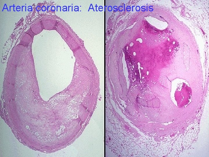 Arteria coronaria: Aterosclerosis 