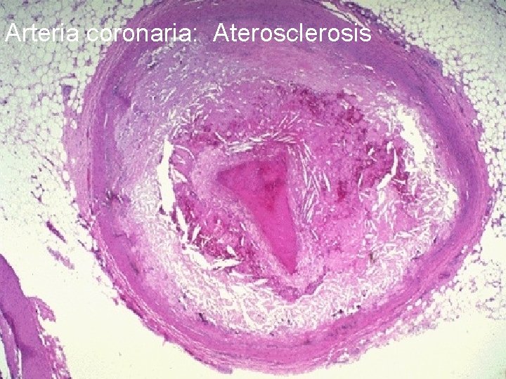 Arteria coronaria: Aterosclerosis 