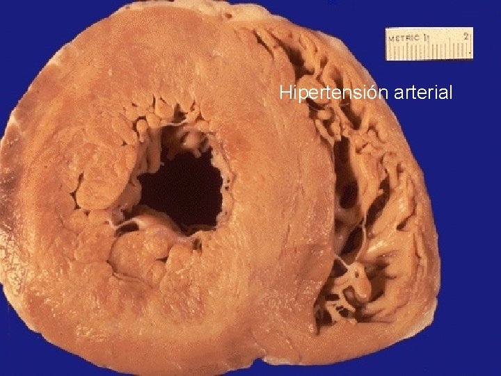 Hipertensión arterial 