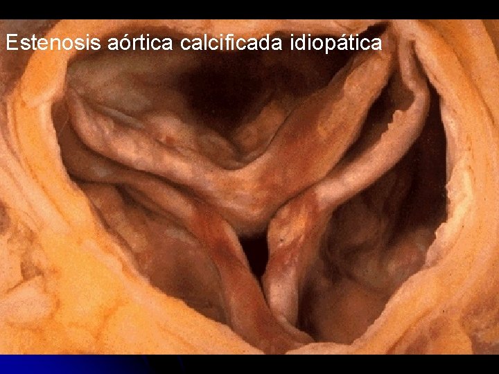 Estenosis aórtica calcificada idiopática 