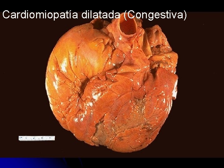Cardiomiopatía dilatada (Congestiva) 