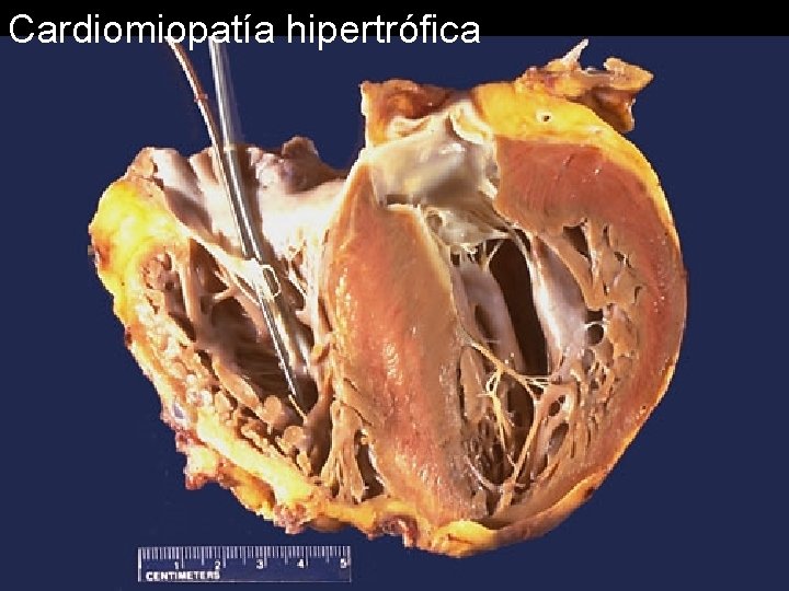 Cardiomiopatía hipertrófica 