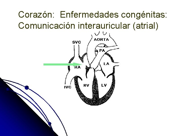 Comunicación (Atrial)congénitas: interauricular Corazón: Enfermedades Comunicación interauricular (atrial) 
