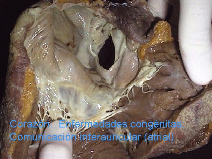 Corazón: Enfermedades congénitas: Comunicación interauricular (atrial) 
