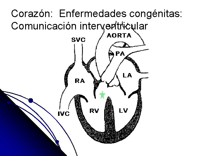 Corazón: Enfermedades congénitas: Comunicación interventricular 