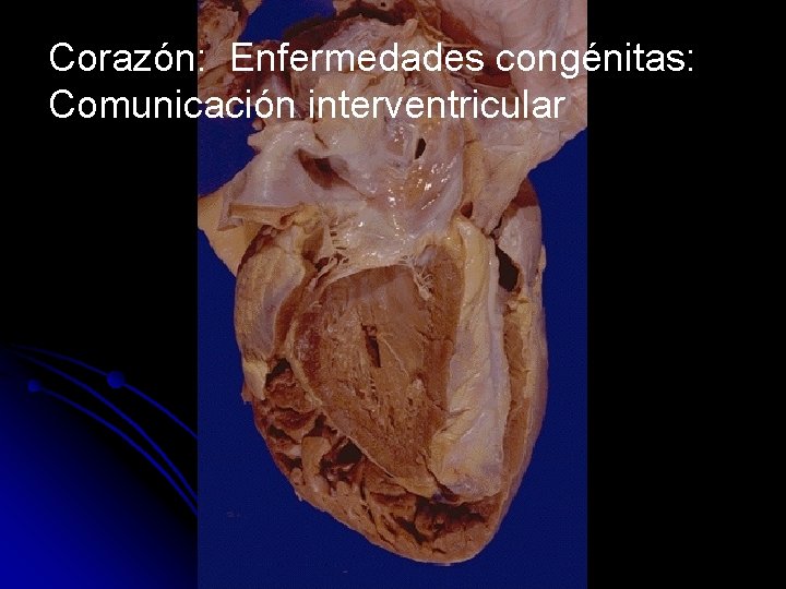 Corazón: Enfermedades congénitas: Comunicación interventricular 