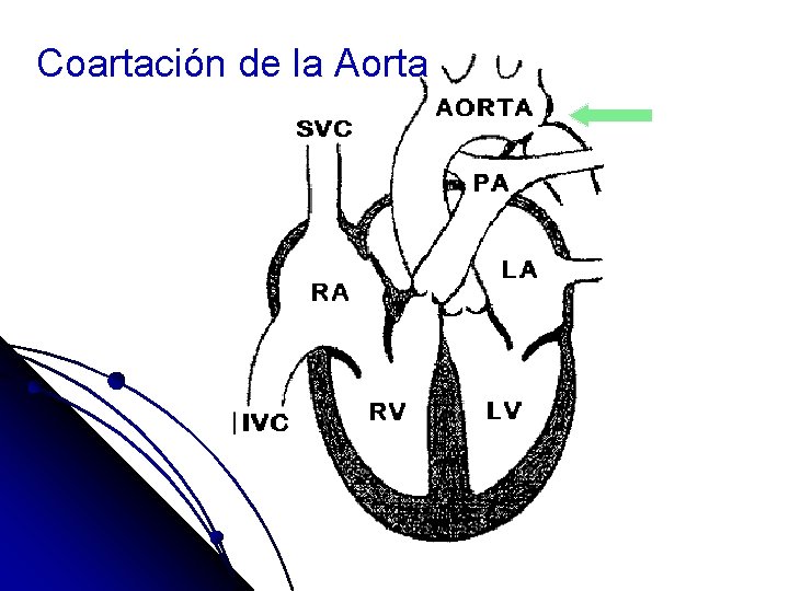 Coartación de la Aorta 