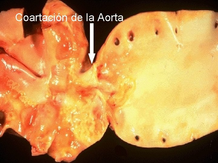 Coartación de la Aorta 