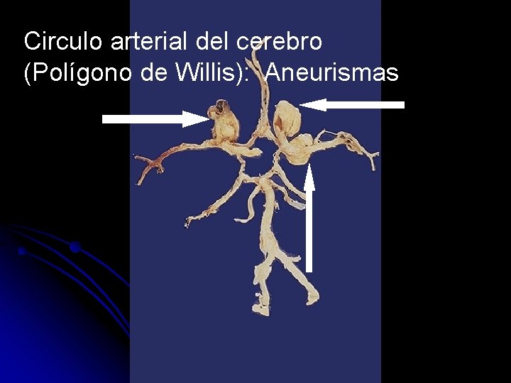 Circulo arterial del cerebro (Polígono de Willis): Aneurismas 