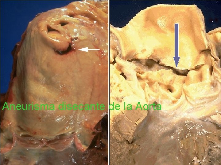 Aneurisma disecante de la Aorta 