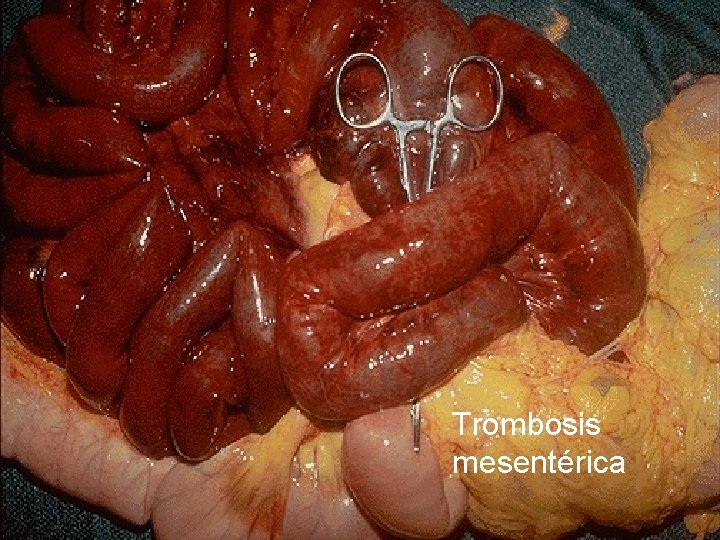 Trombosis mesentérica 
