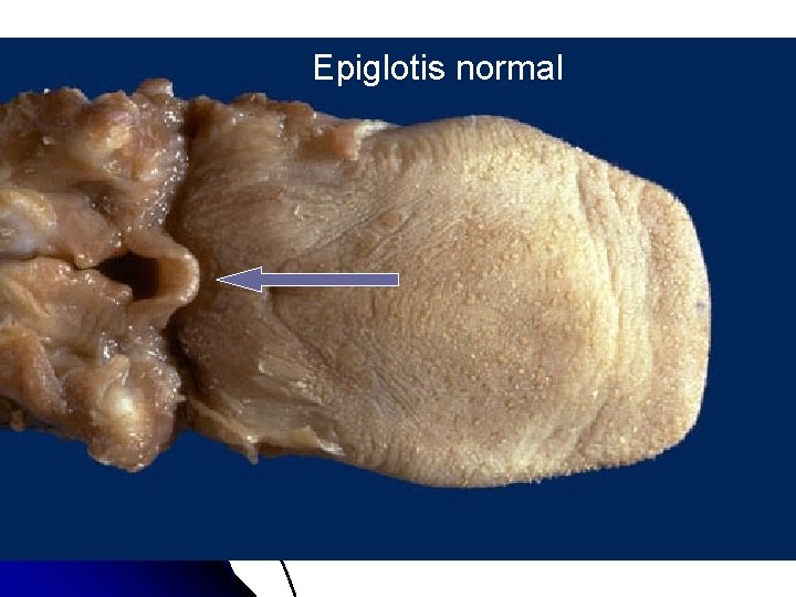 Epiglotis normal 