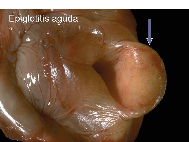 Epiglotitis aguda 