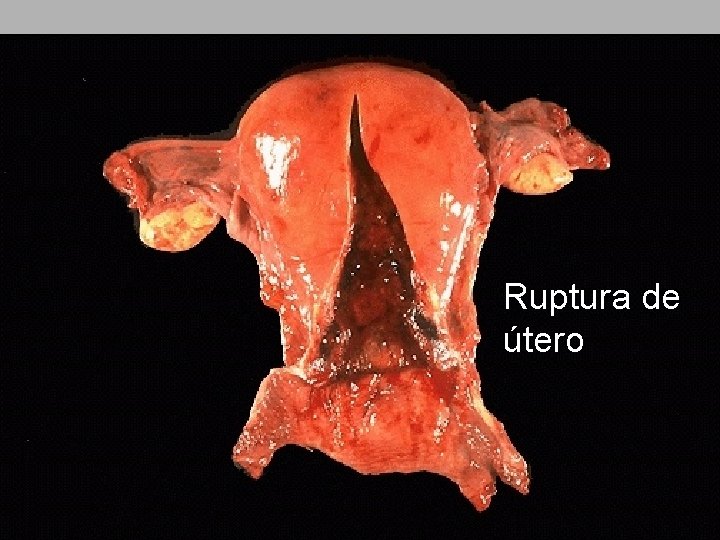 Ruptura de útero 