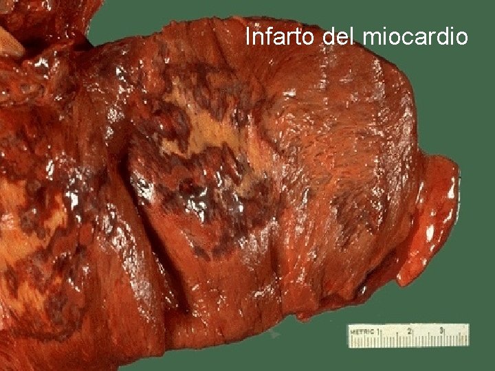 Infarto del miocardio 