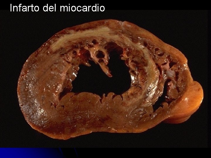 Infarto del miocardio 