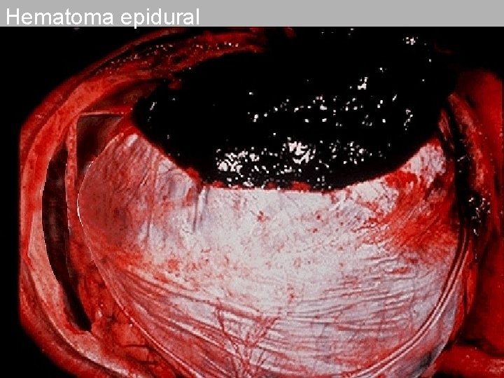 Hematoma epidural 