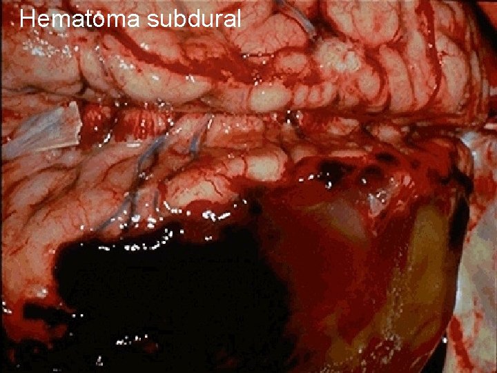 Hematoma subdural 